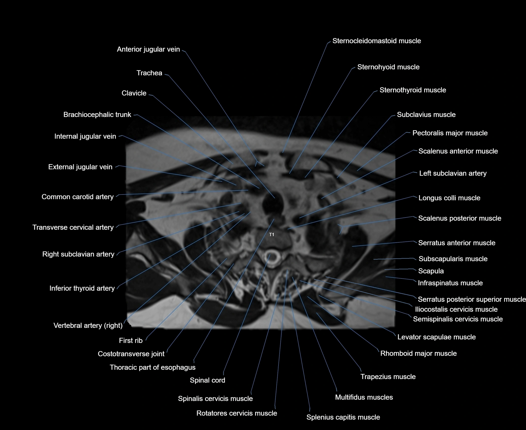 MRI Neck 3D labelled cross section anatomy axial 3t image-00001-00087.webp